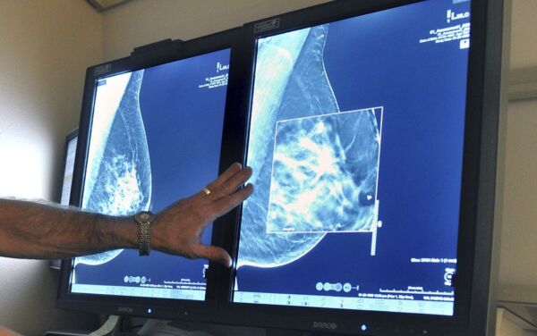 Israelske forskere fant nøkkel til tidlig påvisning av brystkreft
