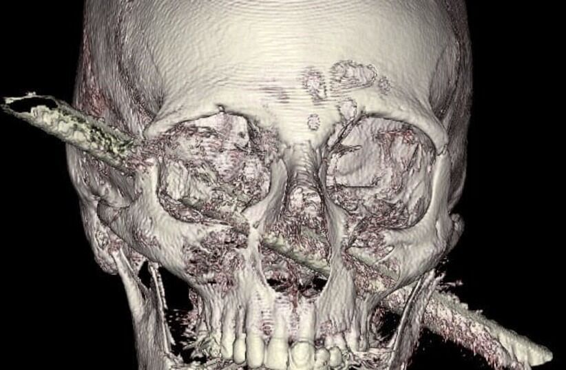 Slik så røntgenbildet av hodet til Kamel Abdel Rahman ut. Han er tydelig på at de medisinske ekspertene ved Hadassah Medical Center i Israel reddet livet hans.
 Foto: Hadassah Medical Center
